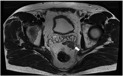 Case Report: Post-traumatic splenosis and potential pitfall for PSMA-PET